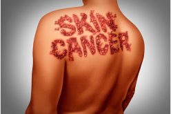 Recuperate From Skin Cancer With Its Diagnosis